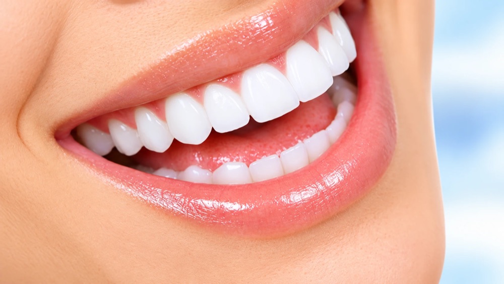 Sonrisa con dientes alineados y blancos, ilustrativa de carillas dentales